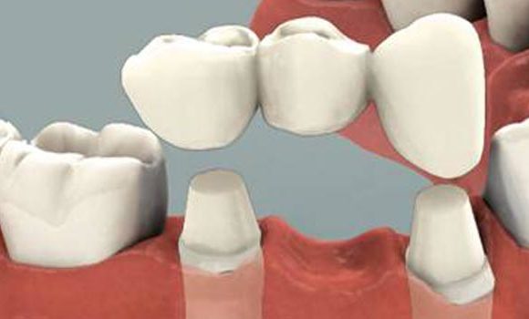 Dental Crowns and Dental Bridges